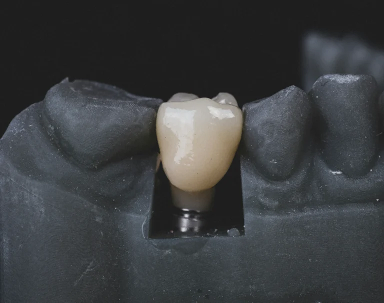 Imagen de apoyo artículo implantes dentales accesibles en Soacha