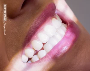 Imagen de apoyo artículo Odontofamiliar aclaramiento dental en soacha